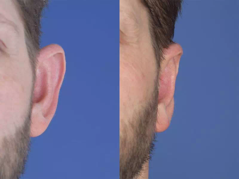 کاندید مناسب برای اتوپلاستی گوش